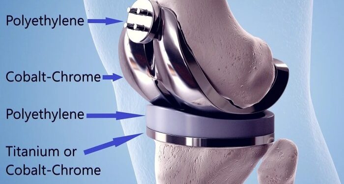 Centurion Orthopaedic Centre What are TKR implants made of? - Centurion ...